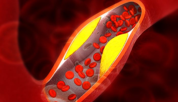 1 de 1 Ilustração colorida de artéria com placa de gordura - Cardiologistas explicam os princi...