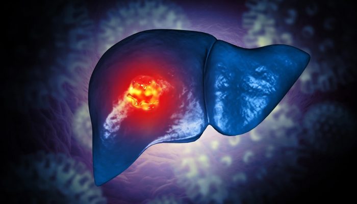 1 de 1 Ilustração de fígado com tumor de câncer - Estudo sugere que reduzir proteína pode de...