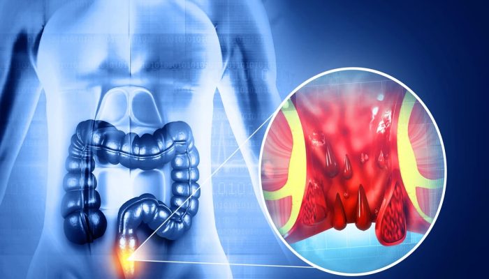 1 de 1 Ilustração médicamostra a formação das hemorroidas - Foto: Getty Images