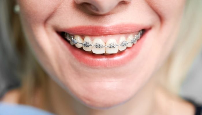 1 de 1 Mulher sorrindo com aparelho ortodôntico - Metrópoles - Foto: Freepik