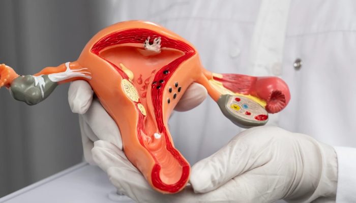 1 de 1 Foto colorida de médico segurando um modelo 3D do útero feminino - Câncer de colo do ú...