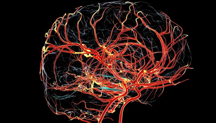 1 de 1 Ilustração de um aneurisma sacular (em forma de baga) na artéria cerebral média, desta...