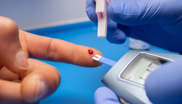 1 de 1 Close-up de um médico com luvas de borracha coletando sangue de um paciente para exame - ...