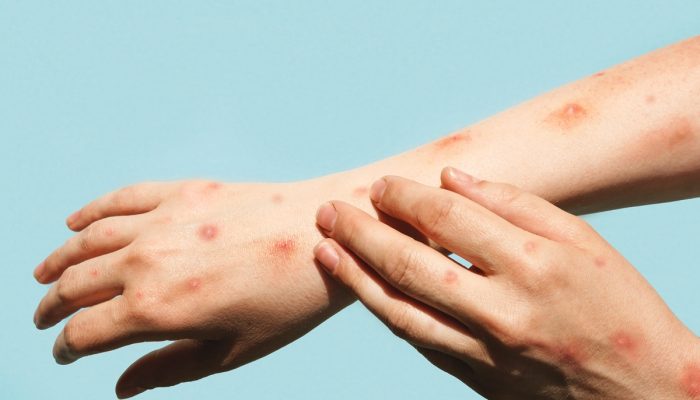 1 de 1 Foto de braços de homens com feridas de mpox - Metrópoles - Foto: Marina Demidiuk/ Getty...